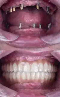 اقساط ویژه ایمپلنت در مرکز تخصصی دندانپزشکی تبریز