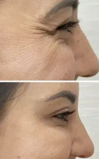 خدمات زیبایی ژل بوتاکس و پی آر پی مزوتراپی....