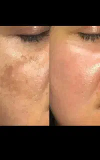 ضدلک بیوممتیک 10کاره