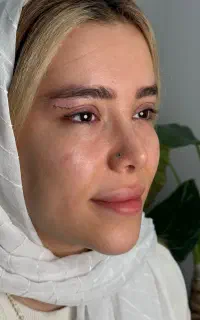 بلفارو لیفت پلک و چشم