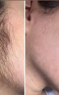 حذف دائمی موهای زائد با الکترولیز