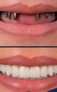 مرکزفوق تخصصی ایمپلنت دیجیتال مشهد/یکروز/کاخ لبخند