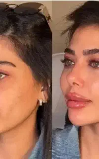 فول فیس/ژل لب/آنزیم بلفارو بوتاکس هایفو تخفیف۶۰٪