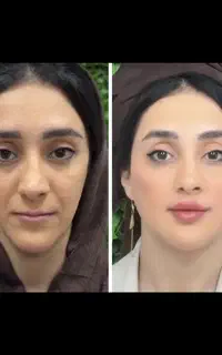 ژل لب و مادلینگ صورت و بوتاکس(فقط هزینه مواد) اپال