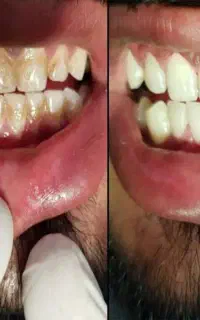 حذف لکه های دندان با تعرفه دولتی