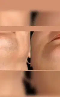 لیزرموهای زائدبادستگاه آلمانی+توصیه بسیار مهم
