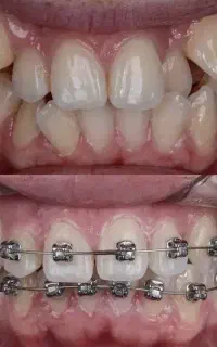 ارتودنسی توسط متخصص*اقساط بدون چک و کارمزد*