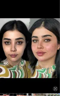 تزریق ژل و بوتاکس و  ابرسانی و جوانسازی پوست