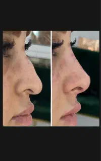 کوچک کردن بینی،رفع قوز بینی،سرپایی،بدون درد