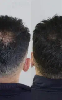 معجزه رویش مو و ریش با این محصول
