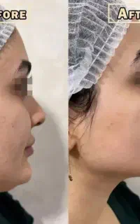 مدرن ترین روش زیبایی لیفت  زاویه ساز