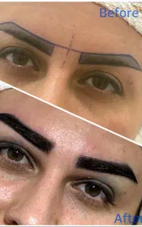 کاشت ابرو به روش میکروگرفت