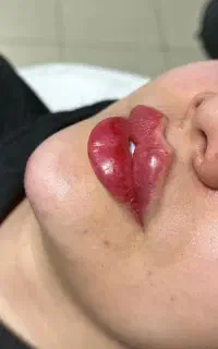 تزریق تخصصی بوتاکس و فیلر .مدل.آموزش تخصصی