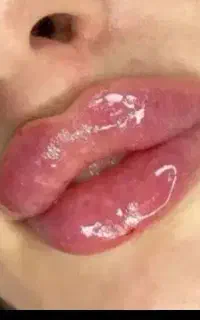 تزریق ژل و بوتاکس و کانتورینگ