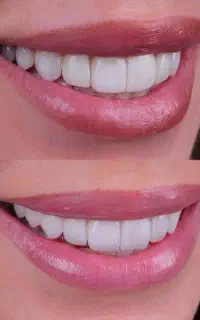 بیمه دندانپزشکی با تخفیف ویژه (اقساطی) در مراغه