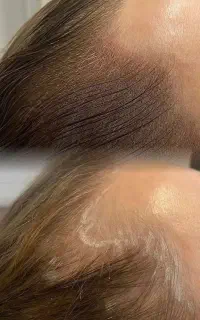 اسکالپ سر