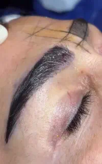کاشت ابرو