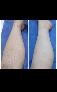 لیزر مو با دستگاه شاتی