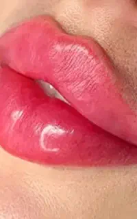 فیلر لب/گونه/چانه/بوتاکس