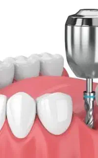 (ایمپلنت دیجیتال دندان 10 تومن نیمه رایگان )