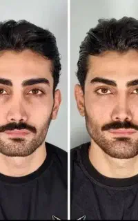 تزریق فیلر،بوتاکس،پک جوانساز،لیزر،مزو تراپی