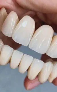 اموزش پروتزهای دندانی(ثابت)