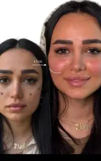 تزریق ژل(فیلر) هم نقد هم اقساط
