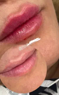 تزریق ژل و بوتاکس در کلینیک تخصصی
