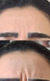 فرصت استثنایی تزریق بوتاکس درجه یک توسط پزشک