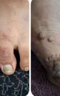 درمان ریشه ای زگیل و تبخال کاملا تضمینی