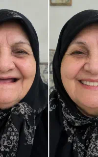 دندان مصنوعی با تخفیفات ویژه دندانسازی