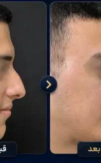 اصلاح فرم بینی بدون جراحی(رفع قوزوانحراف بینی و..)
