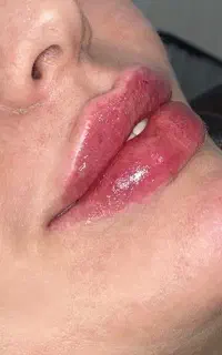 لیزر،فیلر،بوتاکس،مزو،فیشال