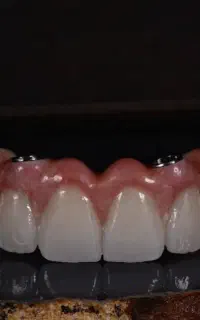 ایمپلنت و اوردنچر کره ای و آلمانی شرایط اقساط ویژه