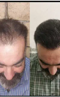 کاشت مو