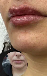 تزریق فیلر،بوتاکس،آنزیم،پیرسینگ