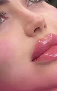 تزریق ژل و بوتاکس