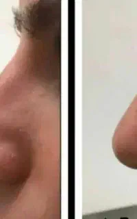 محصولات کوچک کننده و فرم دهنده بینی