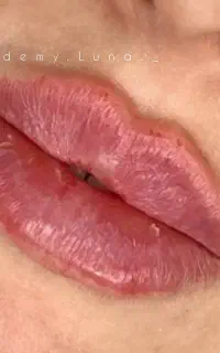 فیلر و بوتاکس
