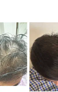 اسکالپ اسکراب/درمان ریزش مو/رشد مجدد مو/پاکسازی سر