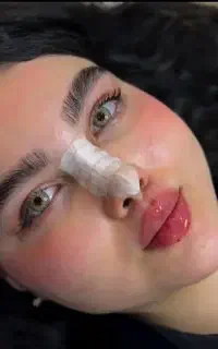 خدمات تخصصی ژل بوتاکس فیلر توسط پزشک
