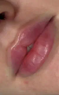 ژل بوتاکس فیلر مزو پی ار پی در مطب زیبایی