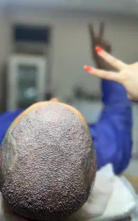 تضمینی موهاتو فول تراکم بکار+پی ار پی مزو بوتاکس