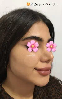 ژل800بوتاکس950