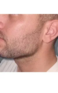 تزریق بوتاکس،فیلر و prp ،مزوتراپی،مزوژل