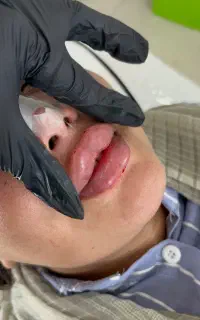 اموزش تخصصی ژل و بوتاکس