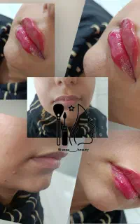 ژل،فیلر، بوتاکس جوانساز مزوژل