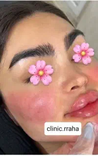 جشنواره ژل و بوتاکس ( تخفیف عید)