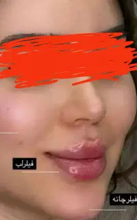 خدمات تخصصی ژل،فیلر،بوتاکس.میکروبلیدینگ ابرو