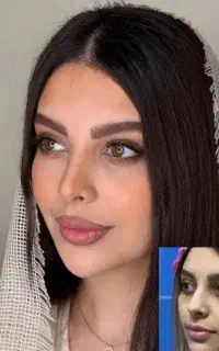 جراحی بینی توسط متخصص گوش،و حلق و بینی/لیفت صورت